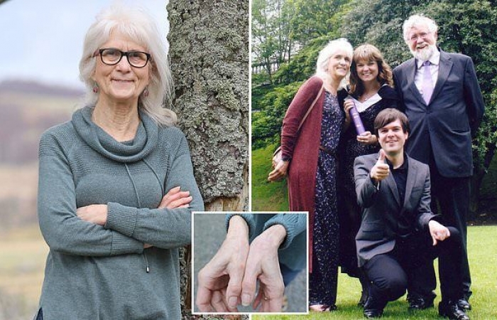 A Woman With A Rare Genetic Mutation Does Not Feel Any Pain And Heals Without Scarring